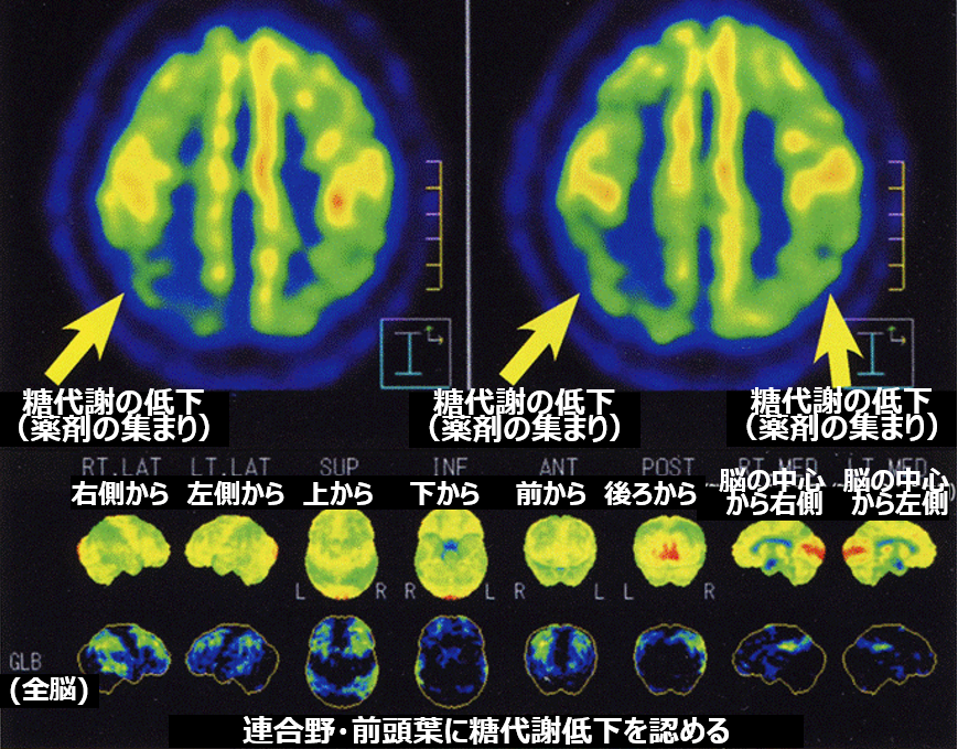 糖尿病でアミロイドβがたまりやすくなり、アルツハイマー型認知症に