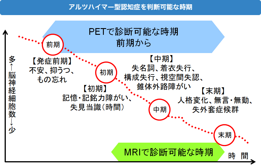 アルツハイマー型認知症を判断可能な時期